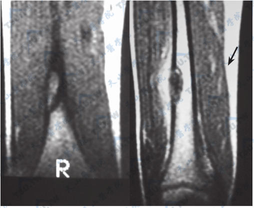 Albright综合征的骨纤维结构不良（MRI）