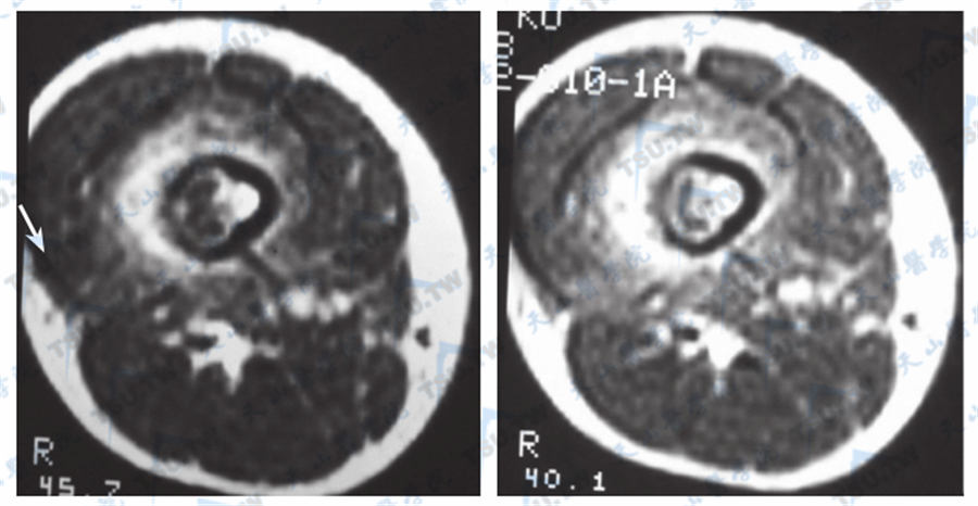  Albright综合征（MRI）