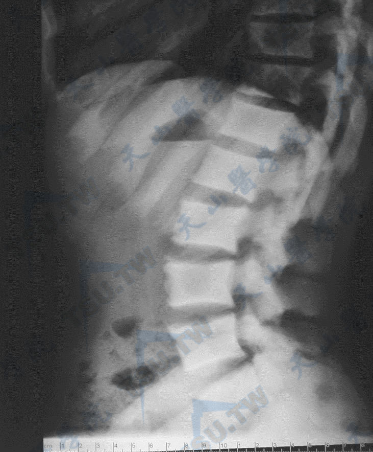 骨质硬化症的腰椎与髋部X线照片（1）