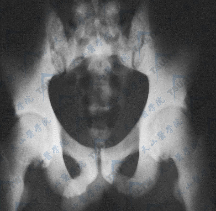 骨质硬化症的腰椎与髋部X线照片（1）