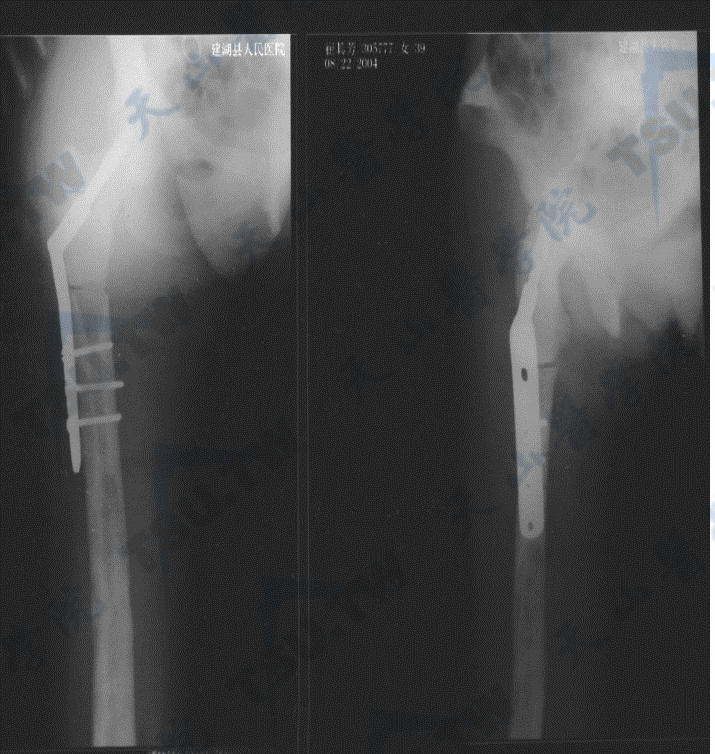 骨质硬化症的腰椎与髋部X线照片（2）