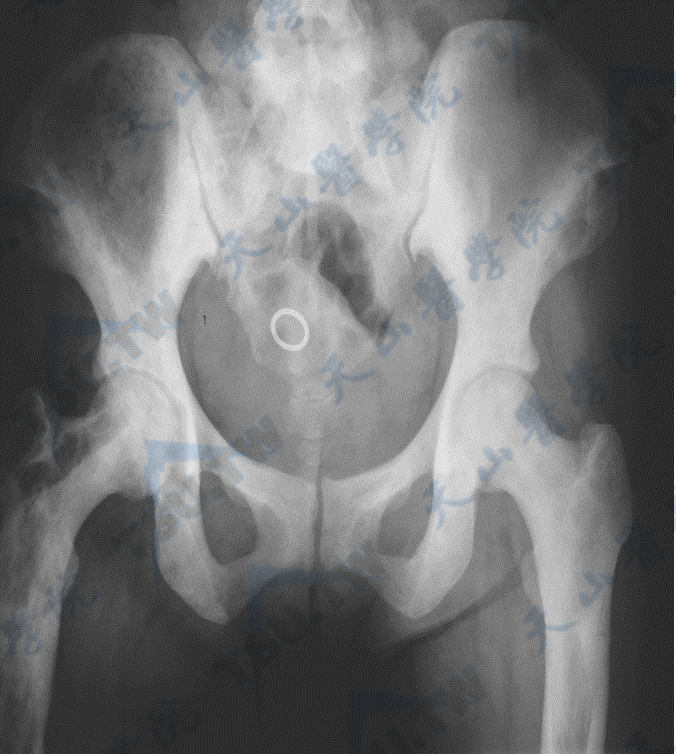 骨质硬化症的腰椎与髋部X线照片（2）