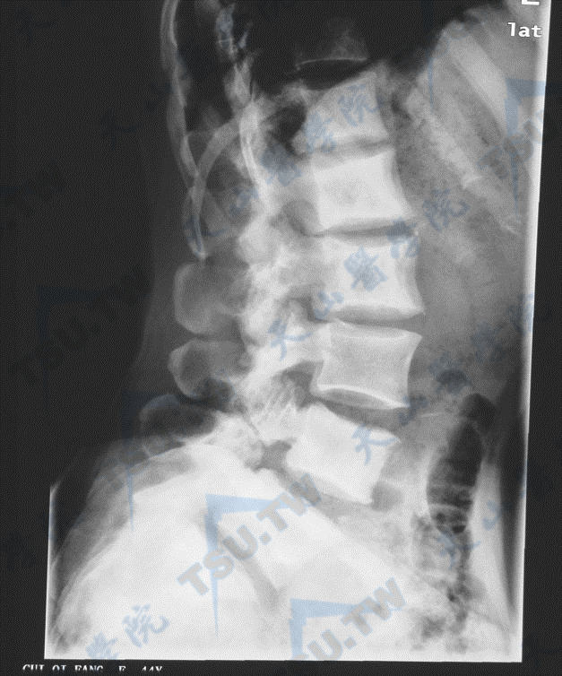 骨质硬化症的腰椎与髋部X线照片（2）