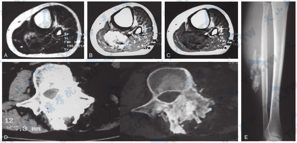  骨化性肌炎（MRI）