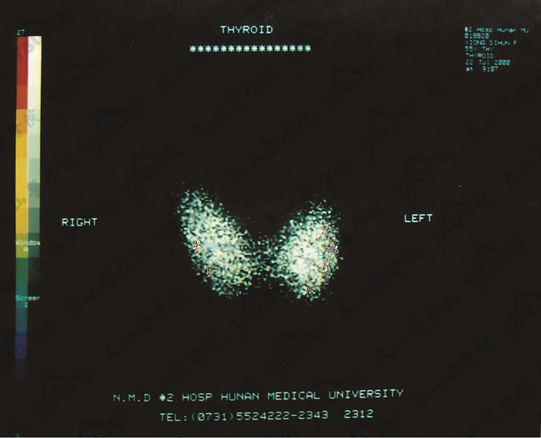 正常甲状腺99mTc显像