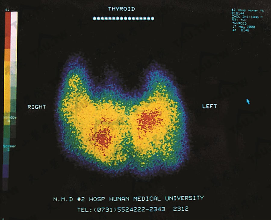 Graves病核素显像