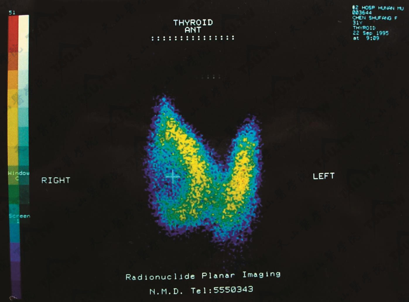 甲状腺“凉”结节核素显像