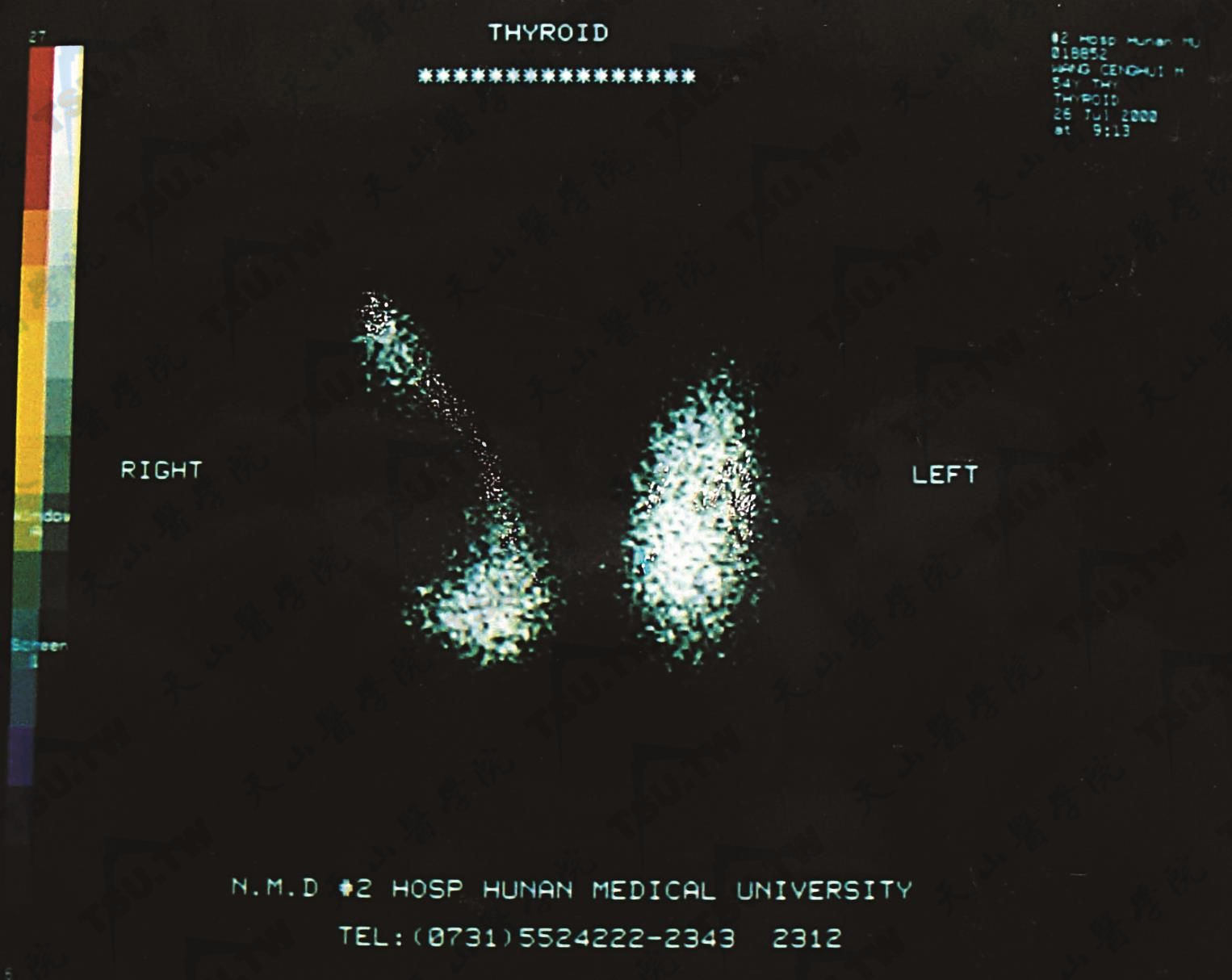 甲状腺“冷”结节核素显像
