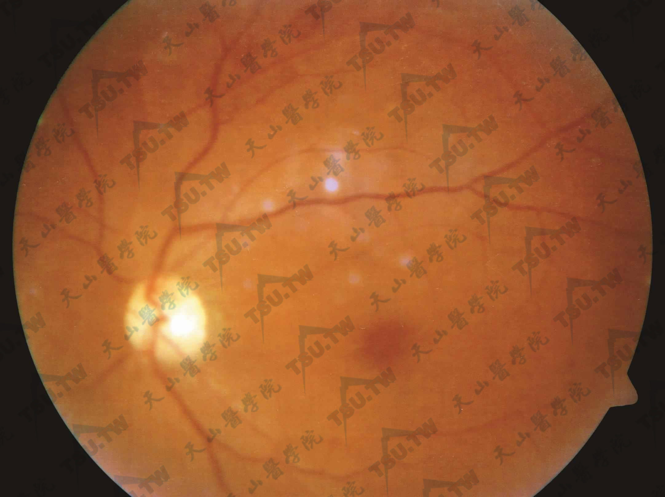  单纯型糖尿病视网膜病变；注：可见微血管瘤，散在点状和片状出血