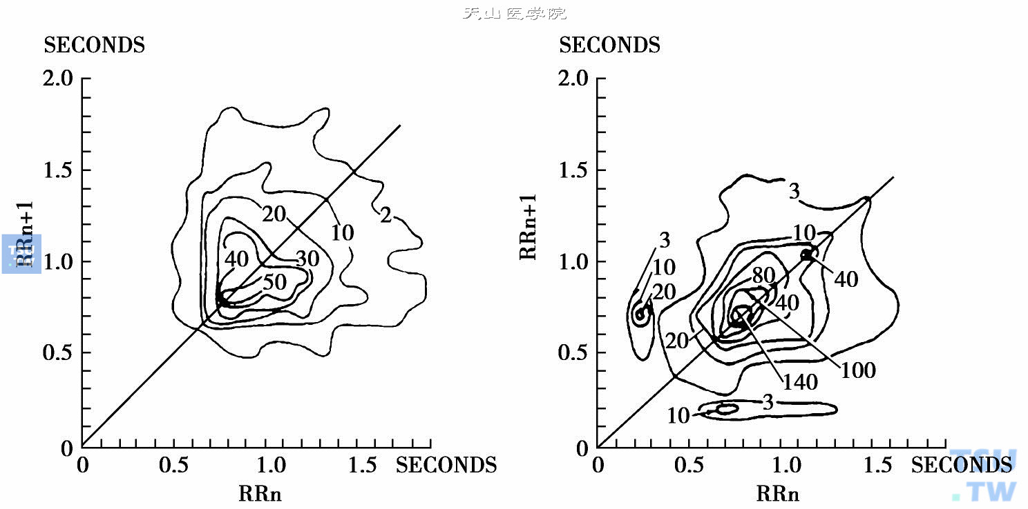  左图是房颤；右图是房颤伴室性早搏［引自Com puters and biom edical research，an international journal，1967，1（2）：146-161］