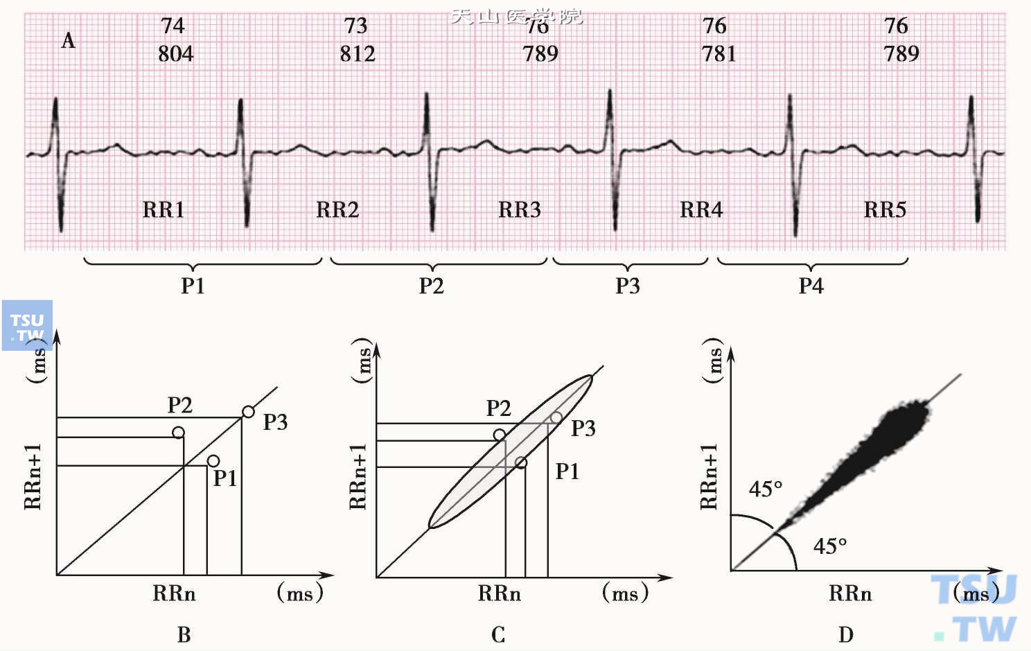 心电散点图作图方法；图1A是正常窦性心律动态心电图片段；取第一个RR间期为X值，第二个RR间期为Y值，做成P1点；再取第二个RR间期为X值，取第三个RR间期为Y值，做成P2点；再取第三个RR间期为X值，取第四个RR间期为Y值，做成P3点（图1B）；然后依此法追踪制作成24小时心电散点（图1C为示意图）；图1D是真实的24小时窦性心律的心电散点图。