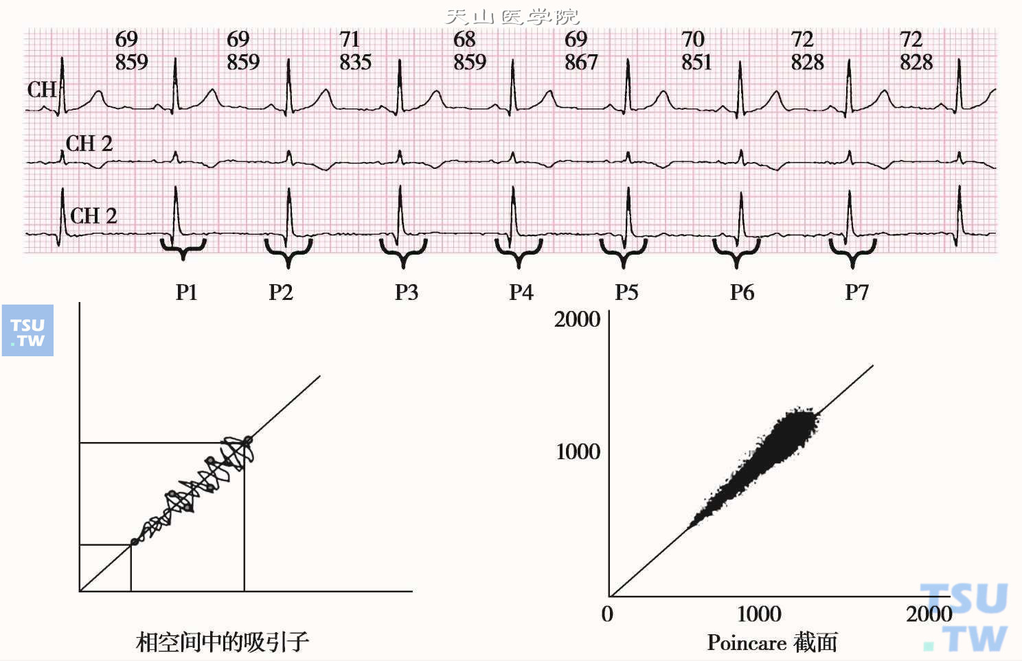  窦性心律系统的吸引子和Poincare截面；左图是正常人窦性心律的吸引子示意图；右图是正常人24小时窦性心律吸引子的Poincare截面，即心电散点图