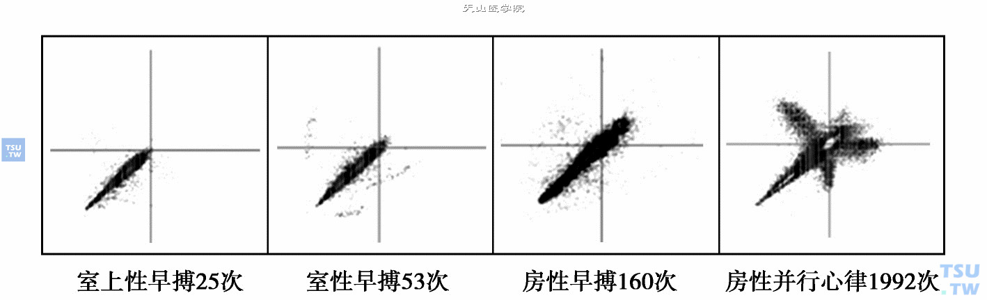  不同心率数据的海量标准：左图的异位心搏有25次，未形成散点集落；左二图异位心搏53次，可见明显的四分布图形；左三图异位心搏160次，但因较散点图分很分散，未形成散点集落；右图异位心搏1992次，形成清晰的吸引子图形；左二图与右图已够“海量”，而其余两图不够“海量”数据