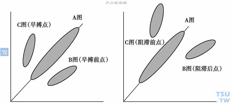  早搏性心律失常与阻滞性心律失常的图形命名：左图是早搏性心律失常图形表现及命名；右图是阻滞性心律失常图形表现及命名