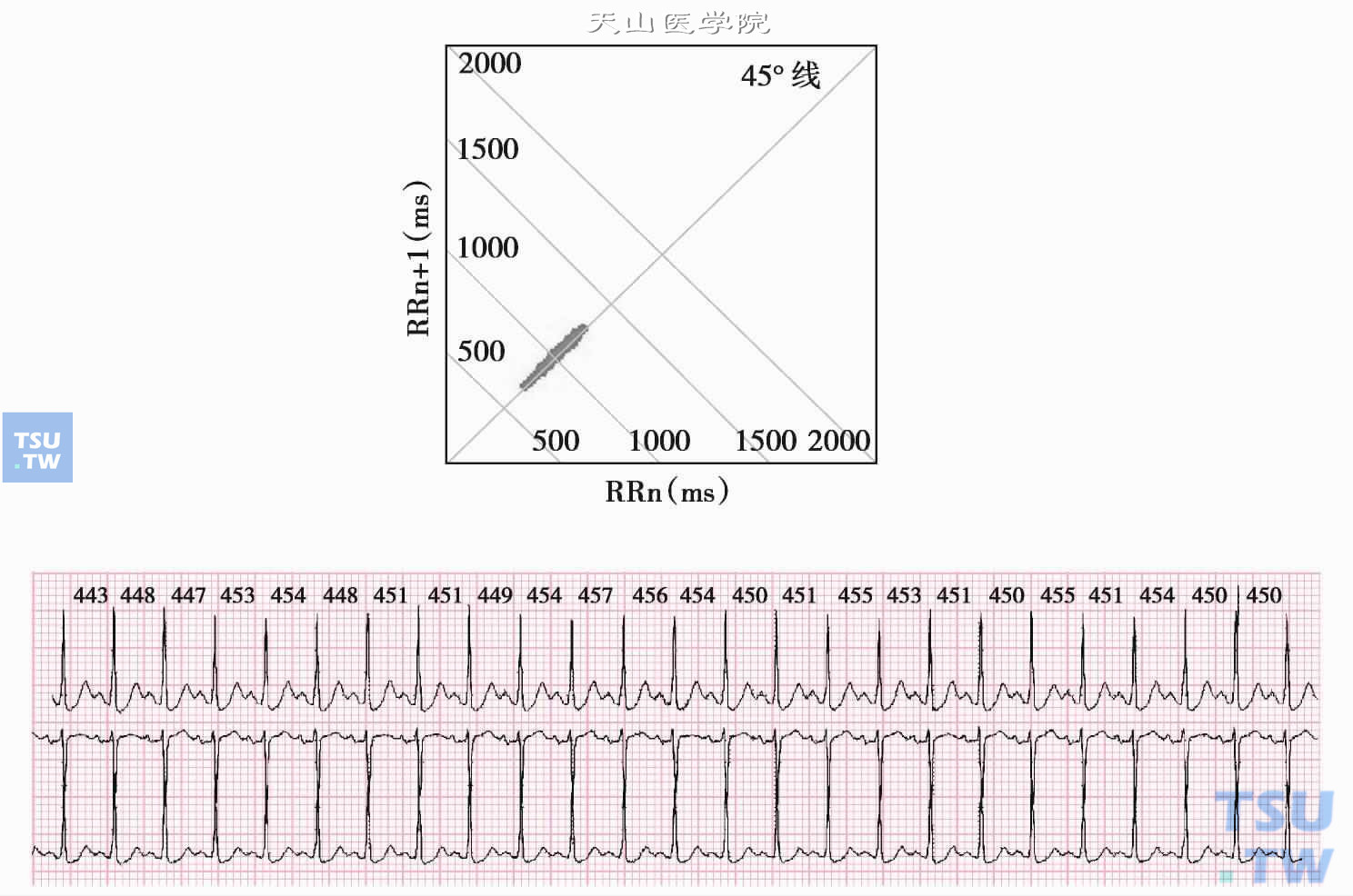  窦性心动过速：图为1小时的心电散点图，图形沿45°线分布，横、纵坐标轴的位置在400～700ms之间，相对应的400～600ms之间为心动过速的散点，而在600～700ms之间的散点为正常心率。下图为相应片段心电图，24个RR间期，平均451ms，变化范围443～457ms。相邻两RR间期差值最小为0ms，最大为5ms。可见窦性心律过快时，节律相对较规整
