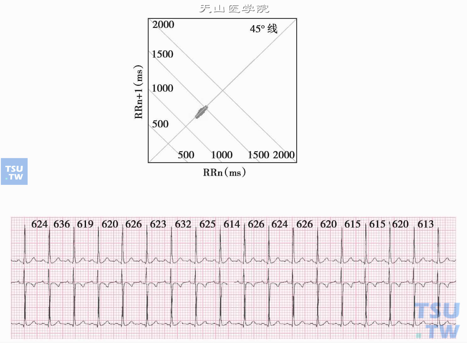  窦性心律的心率变异性降低：图为1小时的散点图，图形沿45°线分布，长轴较短，其横、纵坐标轴的位置在600～780ms之间，其短轴也较短。下图为相应的截取的片段心电图，17个RR间期，平均622ms，变化范围613～626ms。相邻RR间期差值最小为0ms，最大为12ms。可见心率的整体变化范围窄，瞬时变异性亦低