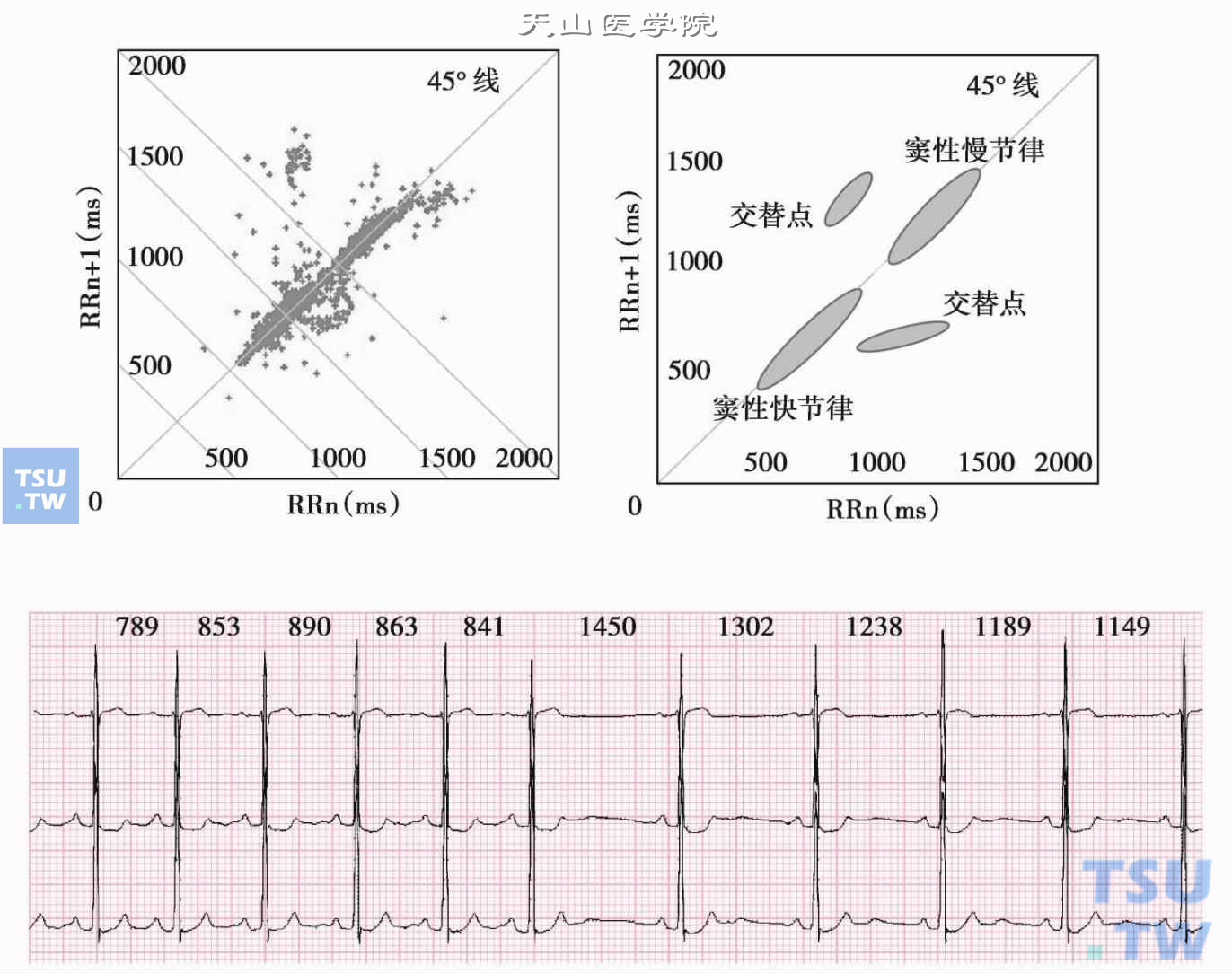 窦房结功能的“纵向”分离：图为1小时的散点图，右上图是其示意图，沿45°线分布着两个棒状稳态吸引子图形，分别由两种窦性节律形成，其交界处附近的加速区和减速区各有一个由两种节律交替形成的非稳态吸引子图形，减速区吸引子表现由快节律转向慢节律，一短一长的两个RR间期，长的RR间期为温醒的节律。下图为相应的片段心电图，总共10个RR间期，前5个RR间期为一种窦性心律，频率周长在789～890ms，平均847ms；后5个RR间期为另一种窦性心律，频率周长为1149～1238ms，长1450ms和1302ms为温醒节律