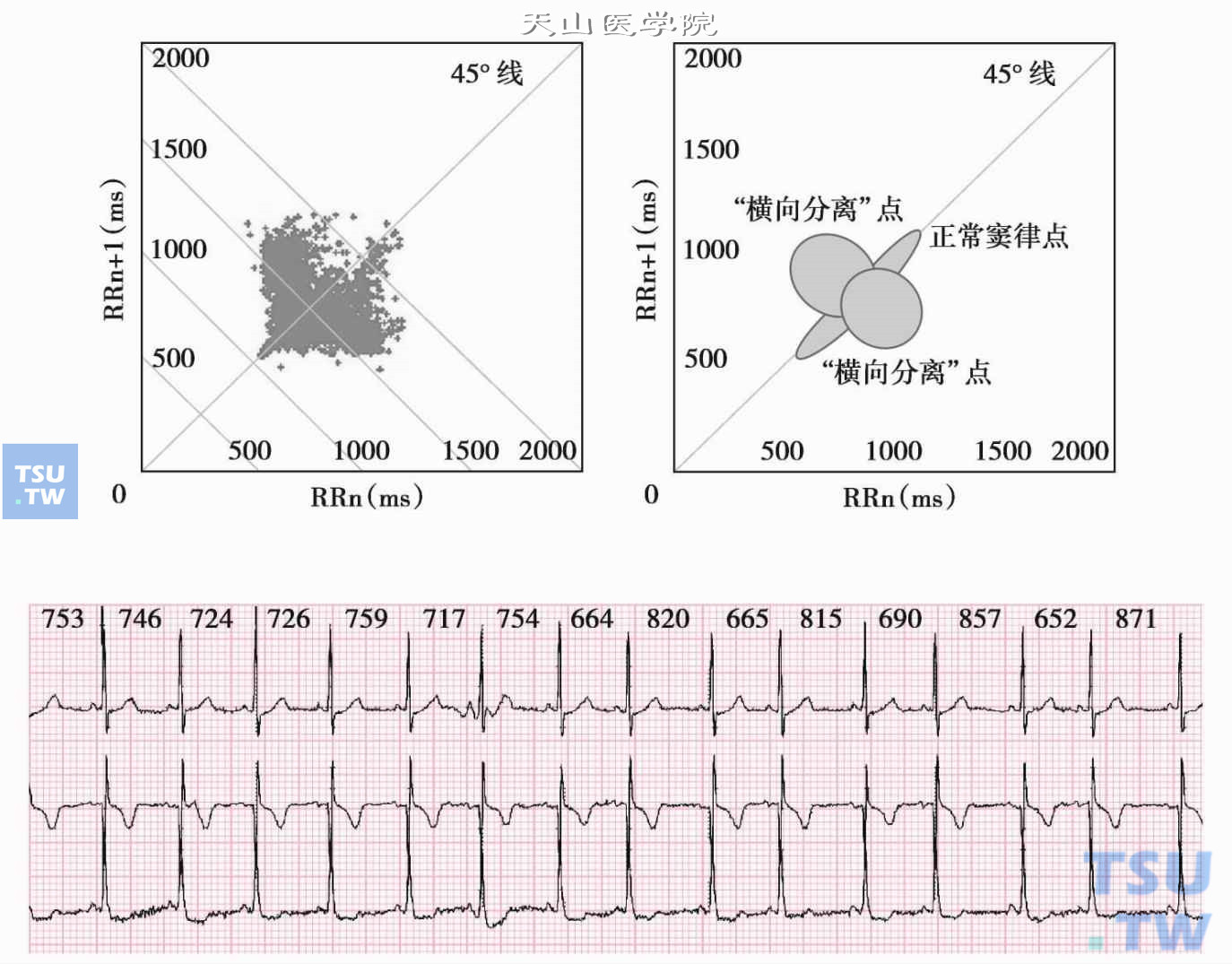  窦房结功能的“横向”分离：图为1小时的散点图，右上图是其示意图，可见散点呈团块分布于45°线两侧，比较对称，从整体上看图形中部向两侧膨出，其实是两个相互有一定重叠的吸引子图形，由“分离”的“窦性并行心律”形成。下图为相应的片段心电图，14个RR间期，平均747ms，变化范围717～871ms。相邻两RR间期差值最小为2ms，最大为219ms，因此瞬时心率变异性有时最大，而节律及不规整不能用窦性心律不齐解释，推测系窦性并行心律所致