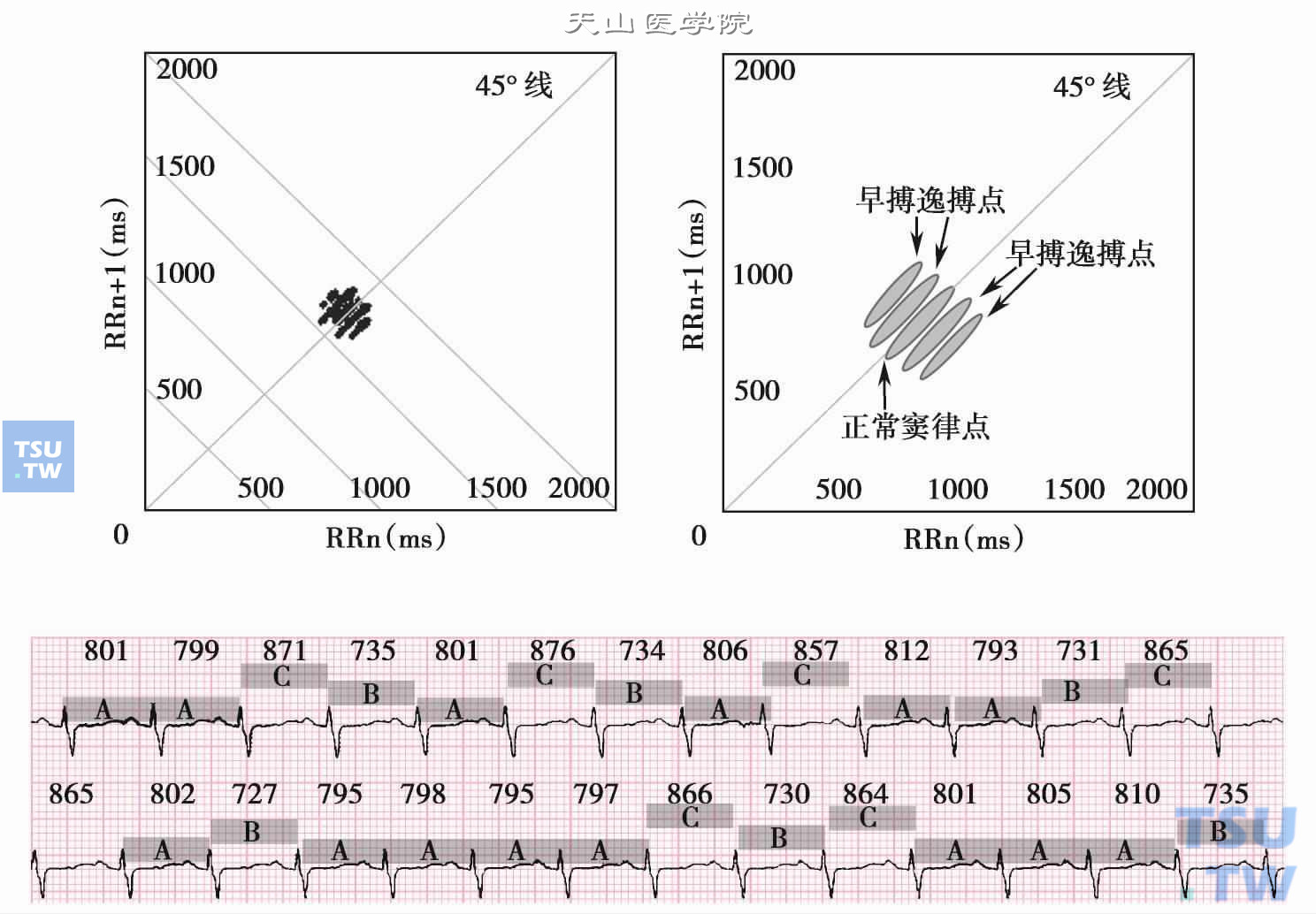  窦性早搏和窦性逸搏：左上图为1小时的散点图，彼此平行的五条“直线”，其中两两关于中间一条对称，均为细短的棒状。