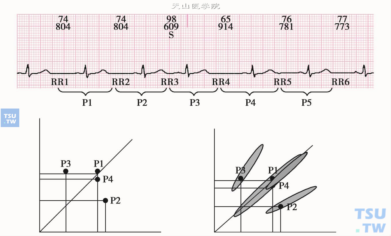 室上性早搏的心电散点图
