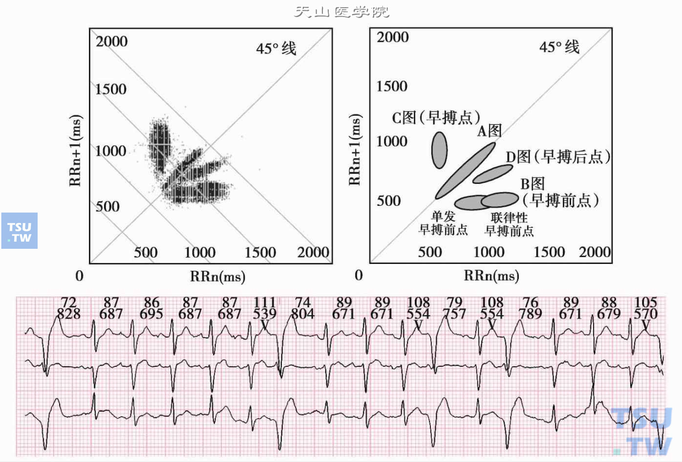 单发室性早搏及室性早搏二联律：左上图是窦性心律伴室性早搏部分呈室早二联律的心电散点图，看似呈四分布，但仔细辨认可见“早搏前点”的吸引子B图由两部分重叠而成，经回放实时心电图显示，单发早搏前点的吸引子在近端，联律性早搏的偶联点吸引子在远端，如右上的示意图所示