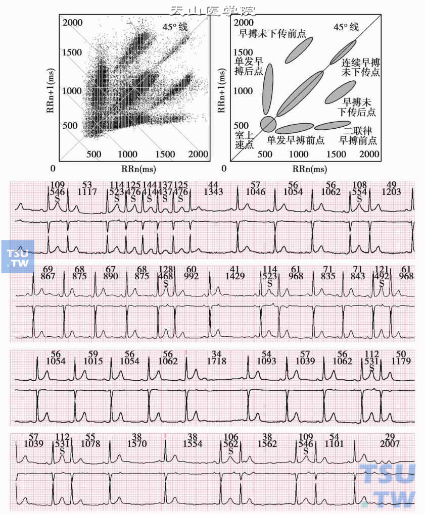 阵发性室上性心动过速及伴室上性早搏的心电图与心电散点图