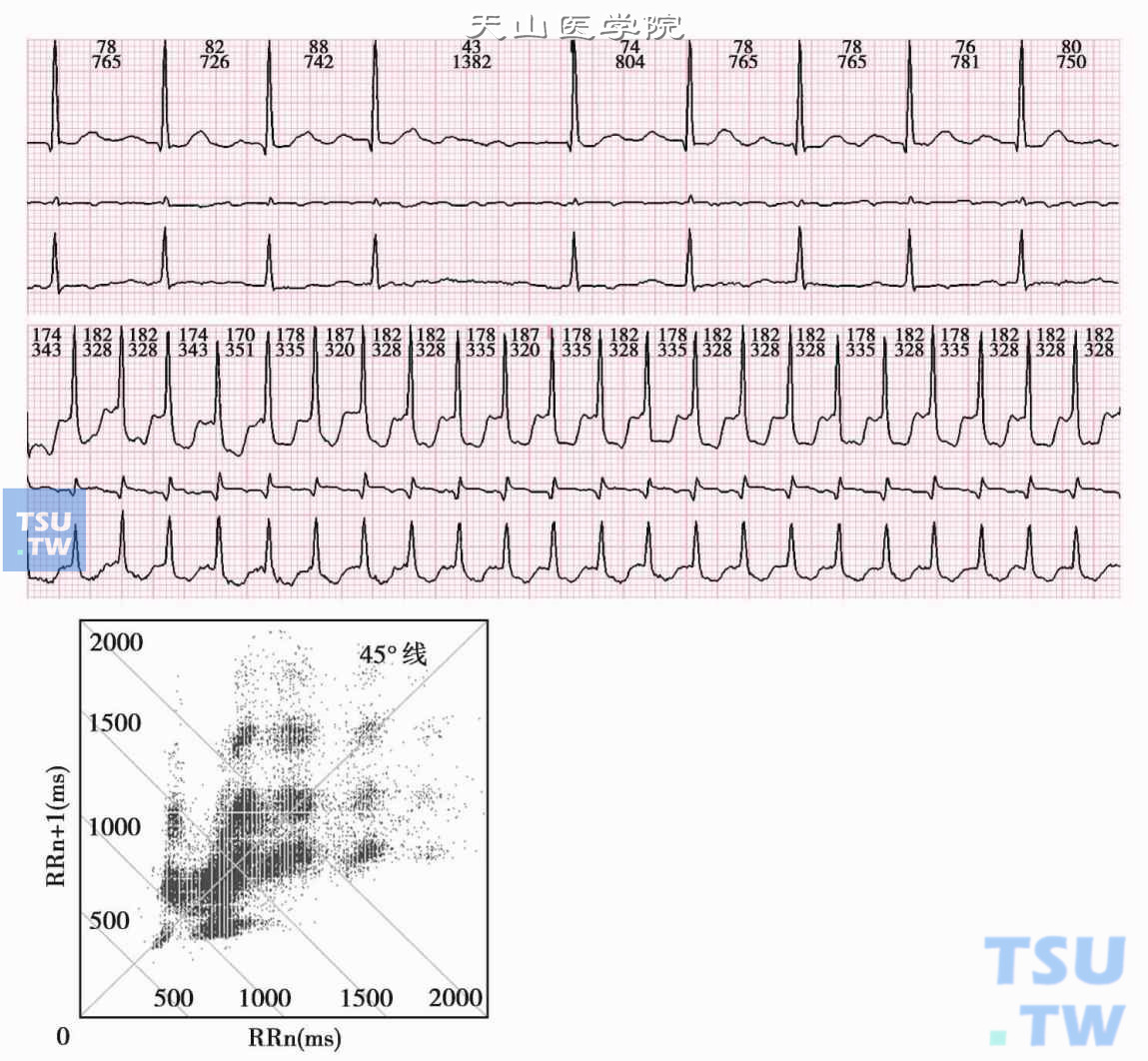 心房颤动与扑动的心电散点图 - 心血管 - 天山医学院