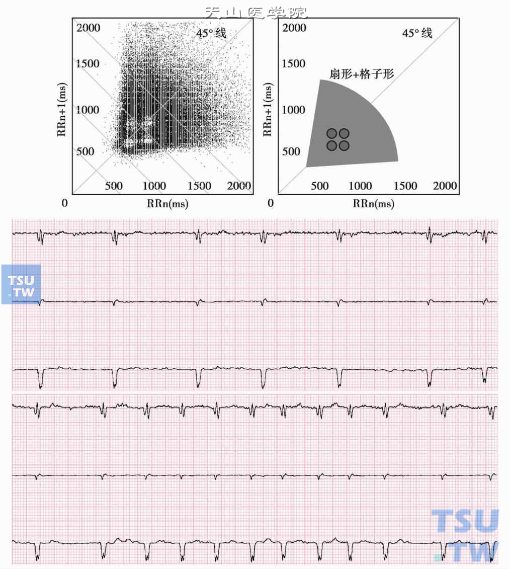  心房颤动伴心房扑动的心电散点图和心电图片段