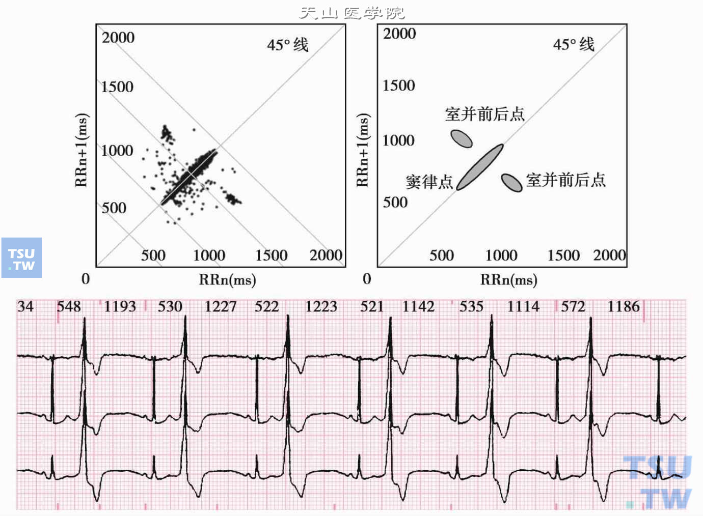 窦性心律合并持续性早搏二联律的室性并行心律