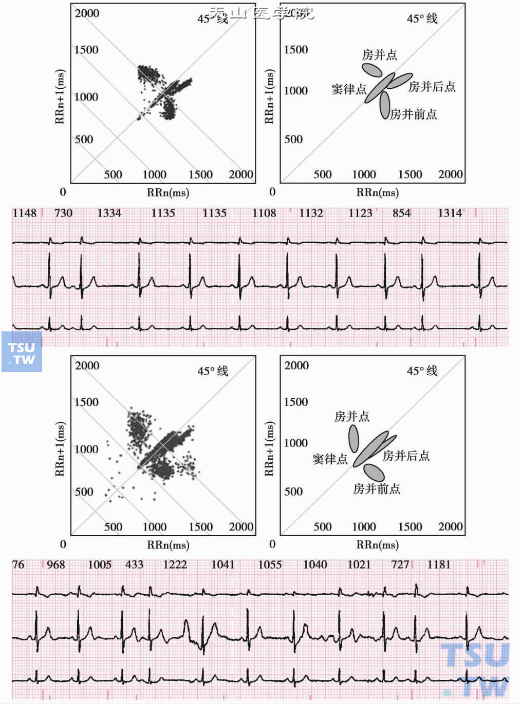房性并行心律的心电图RR序列及心电散点图特征