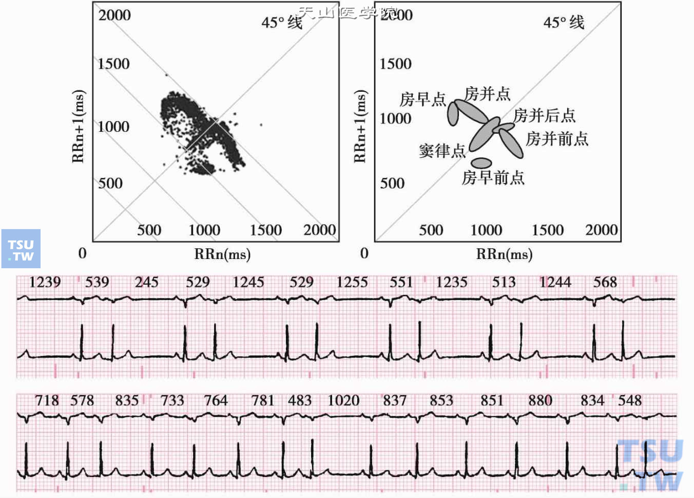 双源性房性并行心律