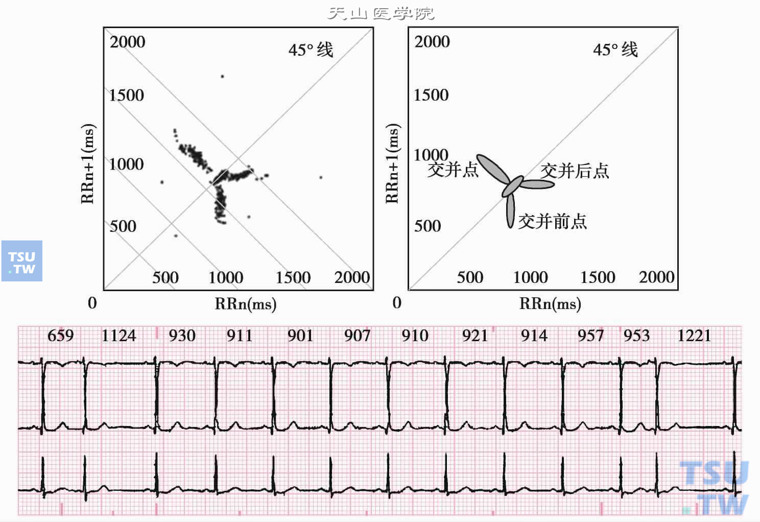 交界性并行心律的心电图RR序列及心电散点图特征