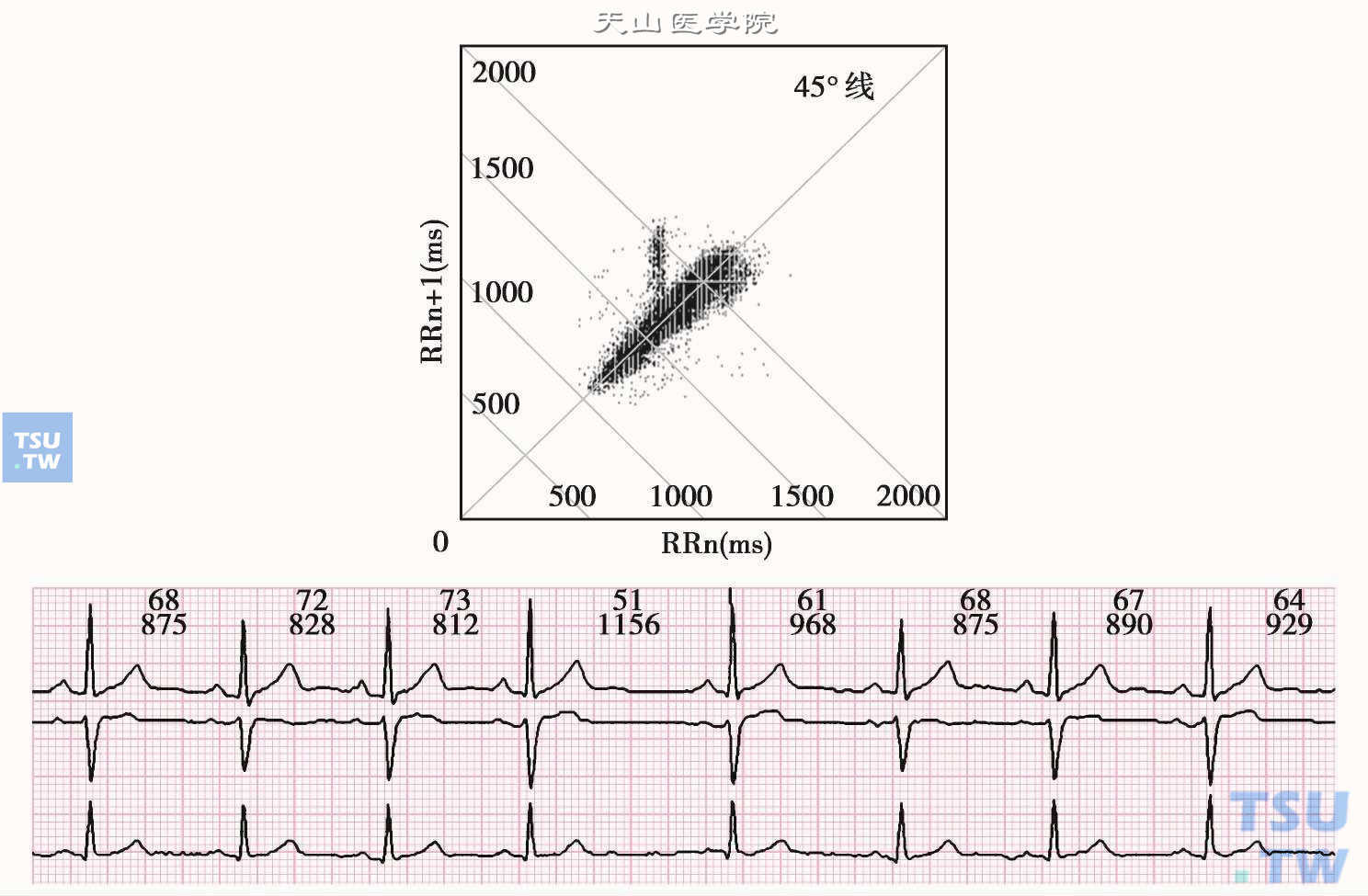 窦房传导阻滞的心电散点图