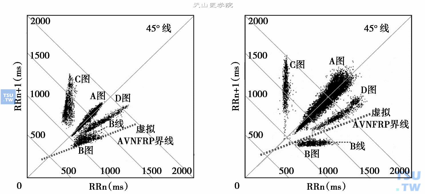  窦性心律伴室性早搏的图形