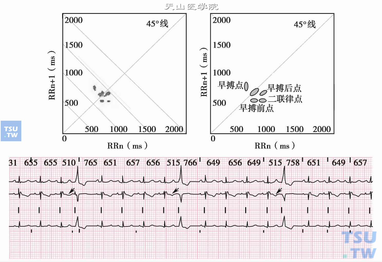 心房感知、心室起搏心律合并房性早搏