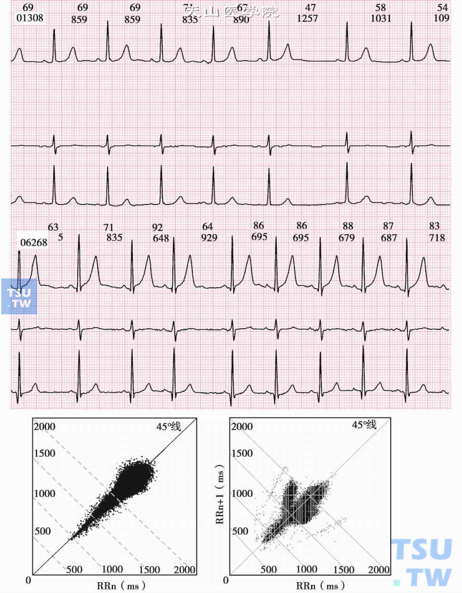 复杂心律失常的心电散点图分析举例