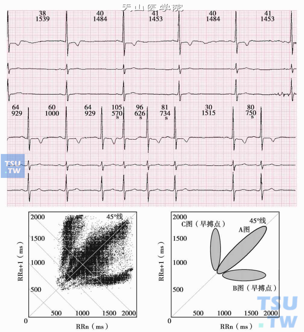 慢快综合征的心电散点图
