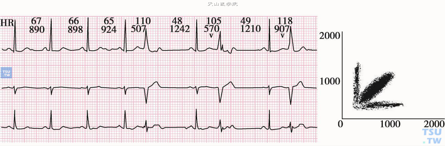 室性早搏二联律发作的三分布图形