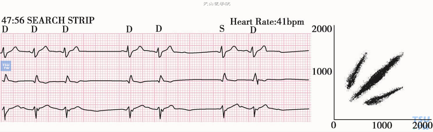 室上性早搏的三分布图形