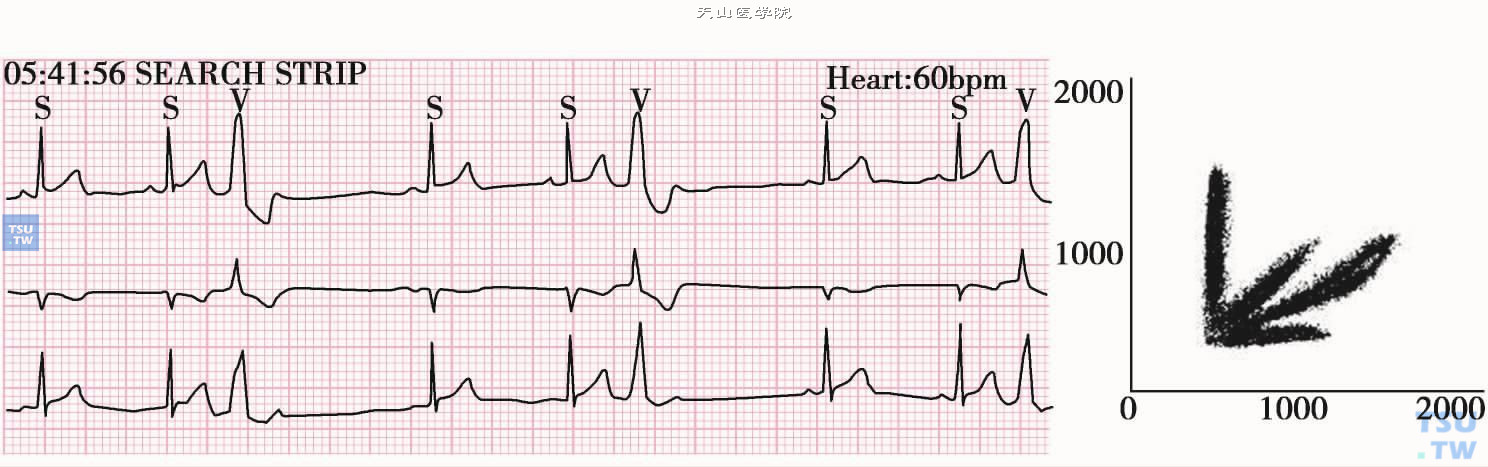 室性早搏图形