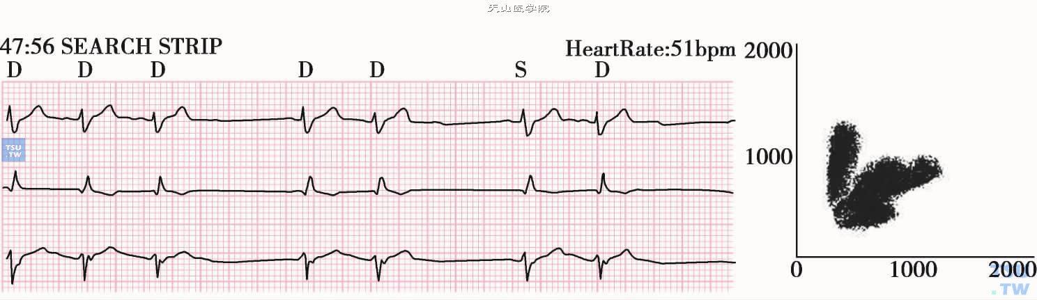 室上性早搏图形3