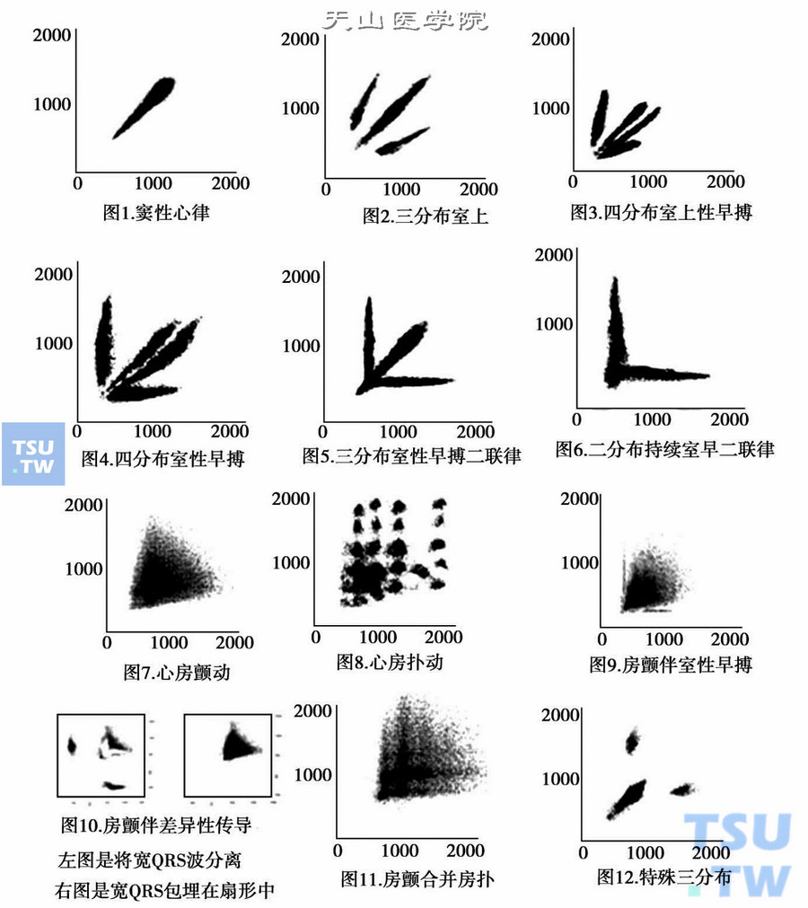 常见心律失常Lorenz图诊断模型