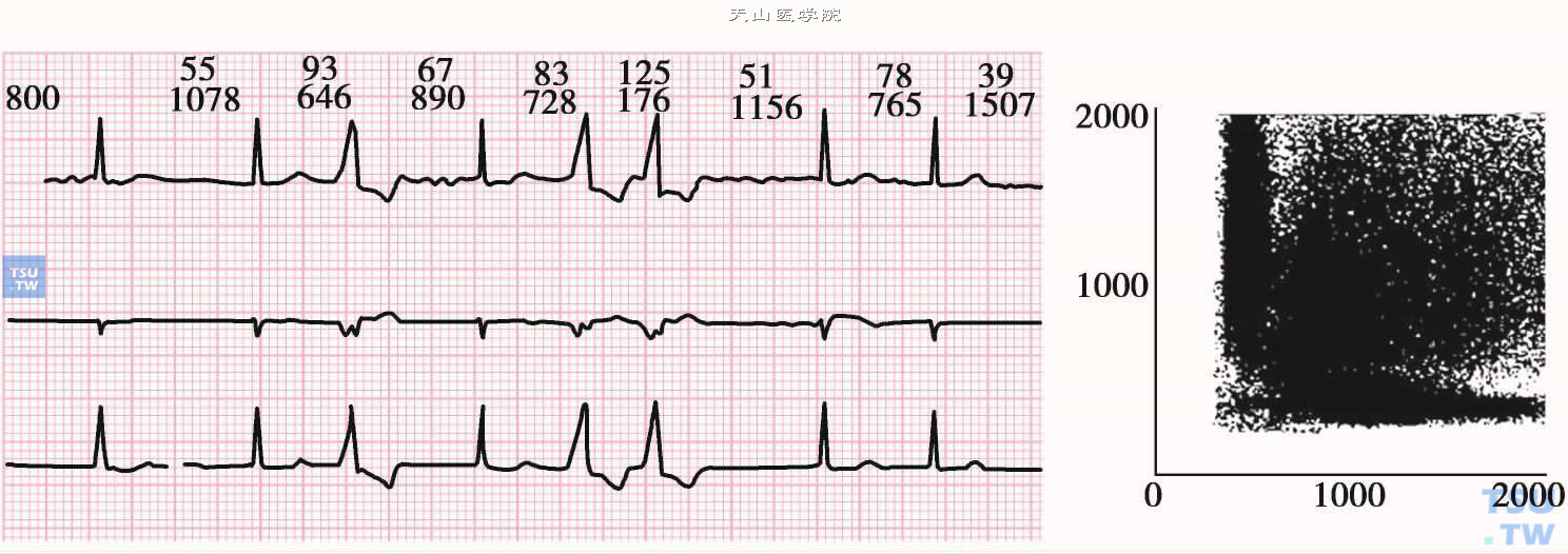 Af伴室性早搏的图形