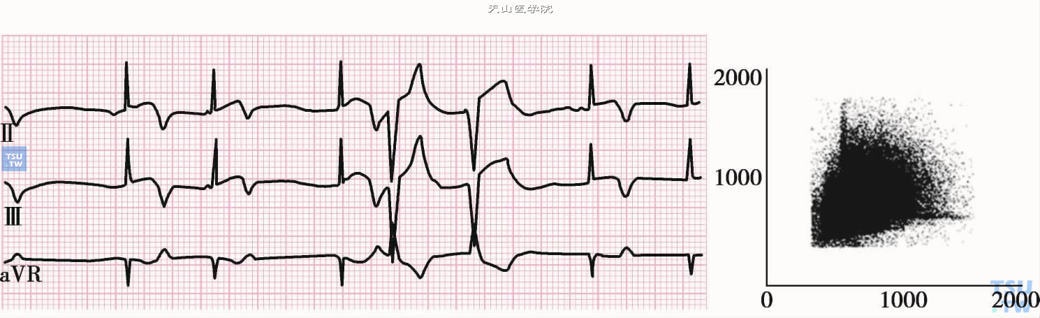Af伴室性早搏的图形