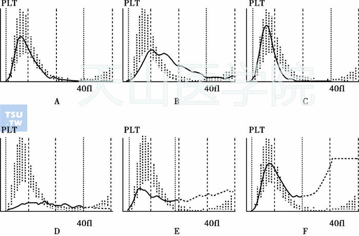 A：正常血小板直方图；B：大血小板直方图；C：小血小板直方图；D、E：血小板聚集直方图；F：小红细胞干扰血小板直方图