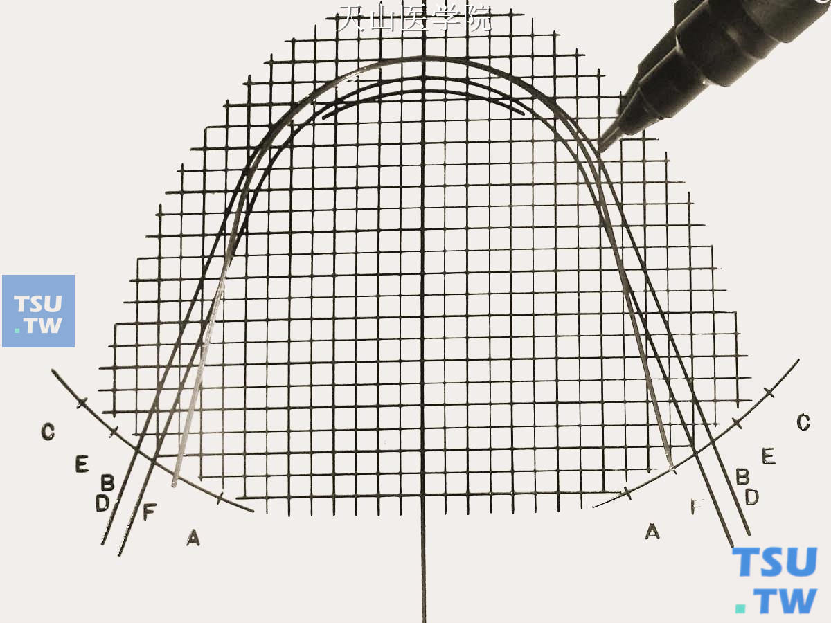 在弓形图版上比对前牙弓形，此时的弓丝后牙区未完全就位，在尖牙区进行标记
