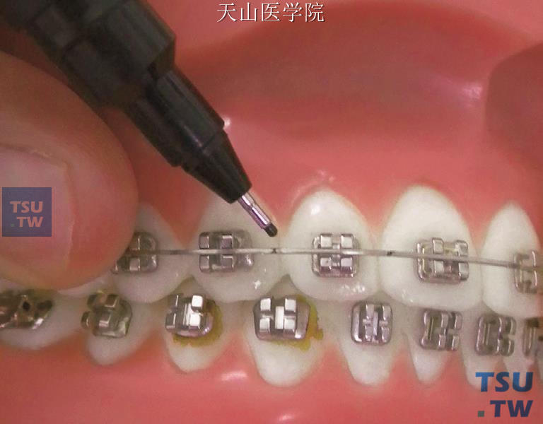 在中切牙与侧切牙、侧切牙与尖牙之间作标记