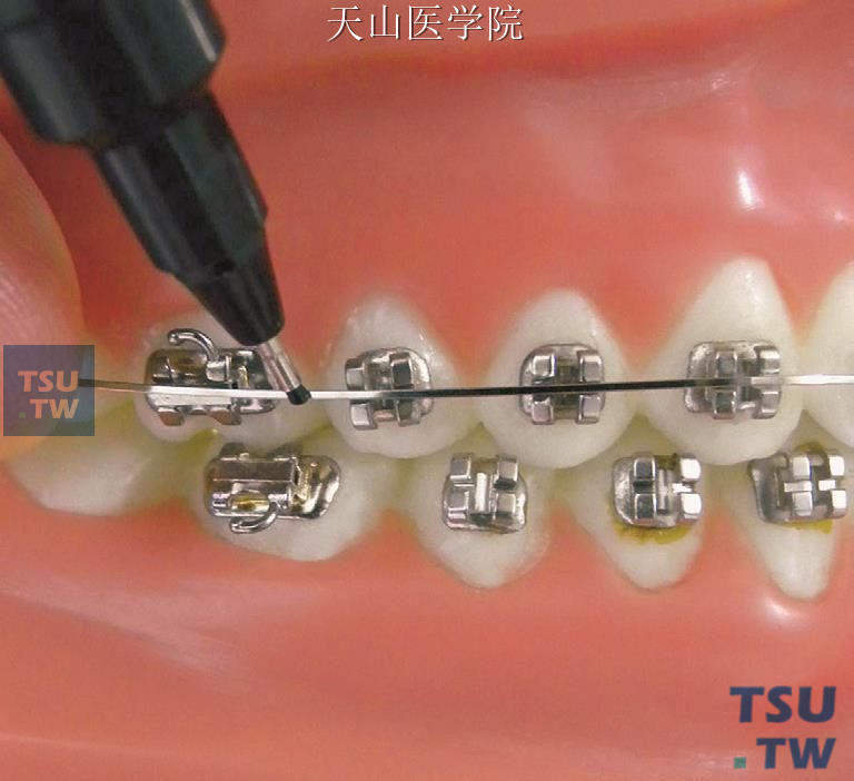 在第二前磨牙与磨牙之间作标记