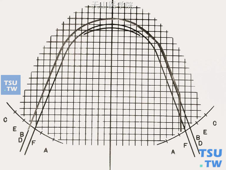 比对弓形图版，弓丝从E点回弯到F点，或与牙弓中线平行，完成磨牙外展弯