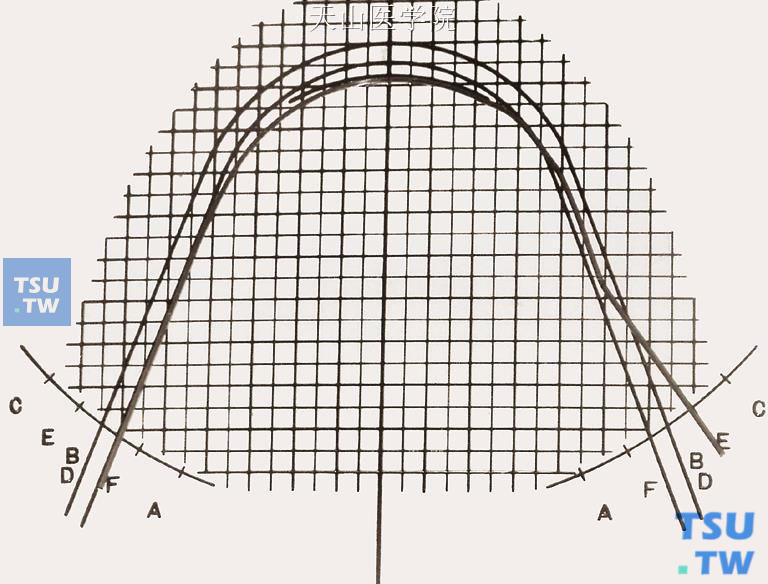 比对弓形图版，弓丝从B（D）点弯制到E点